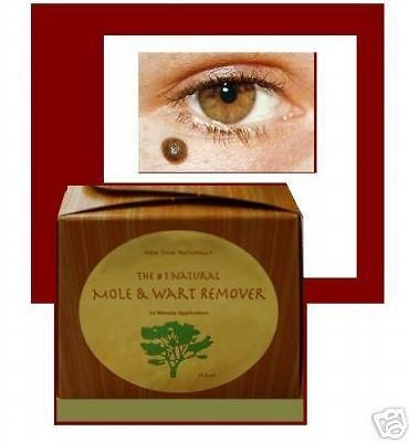 Natural Mole remover  Watch Wart & Skin tag Vanish